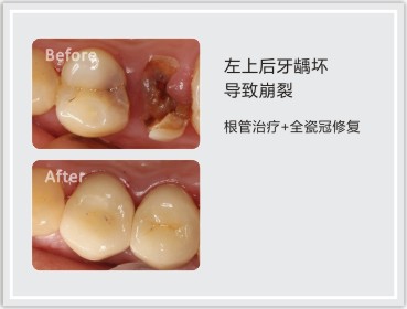 根管治疗+全瓷冠修复