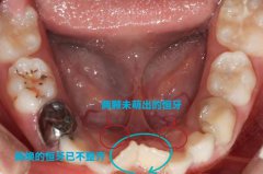 孩子矫正的黄金期